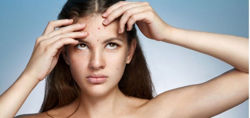 How To Get Rid Of Acne Scars Naturally?