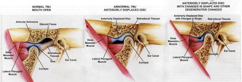 What Causes The TMJ Disorder
