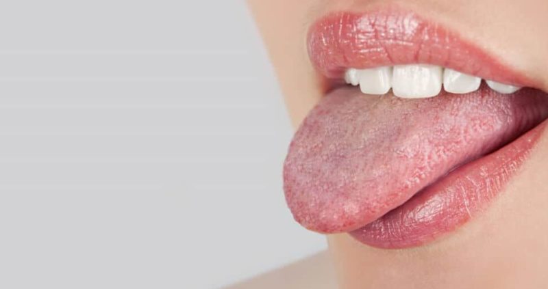 Ayurvedic Tongue Diagnosis : How To Do It, Benefits