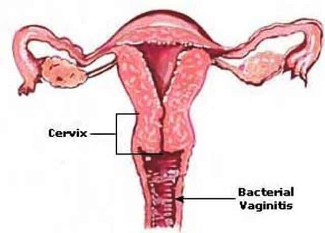 What's Bacterial Vaginosis