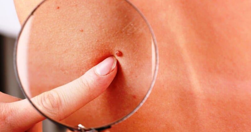 Home Remedies To Remove Skin Tag