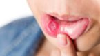 12 Proven Home Remedies For Mouth Ulcers