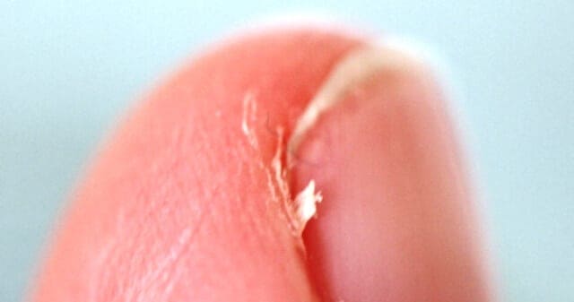Causes Of Hangnails