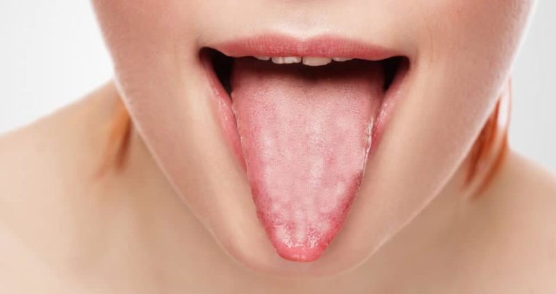 Home Remedies For Tongue Blisters