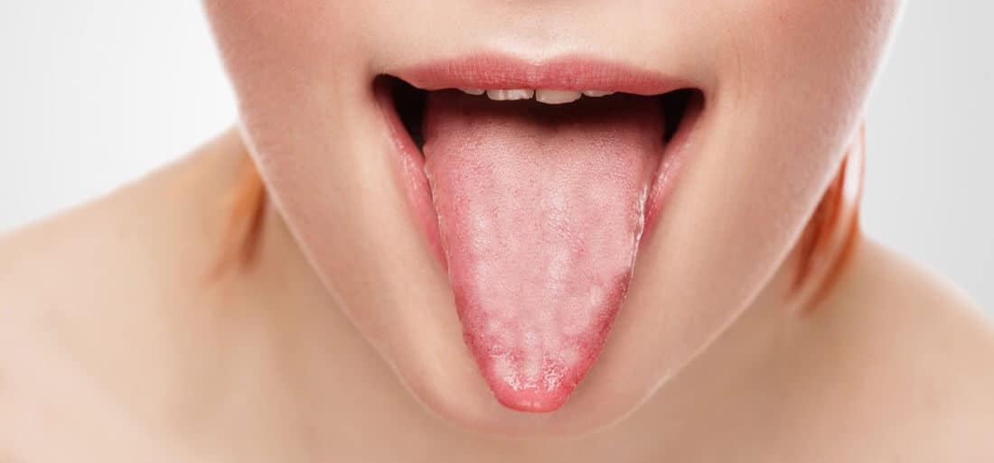 home-remedies-for-tongue-blisters