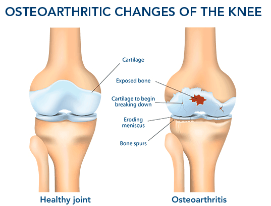 Does Running cause Osteoarthritis In Knee Or Hip?
