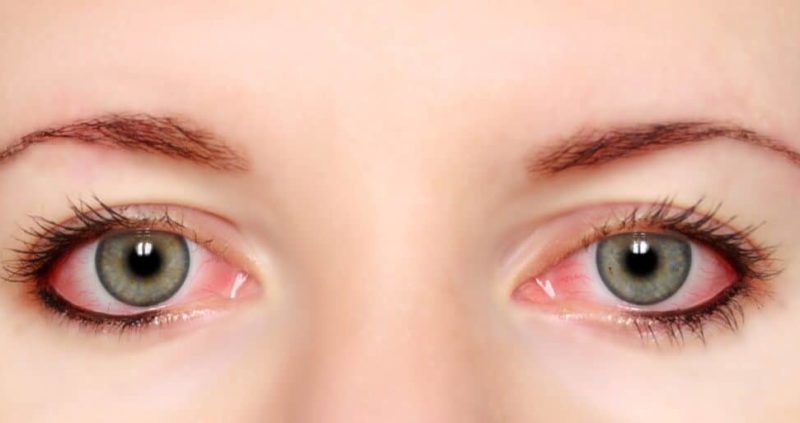 40 Best Natural Remedies For Bloodshot Eye