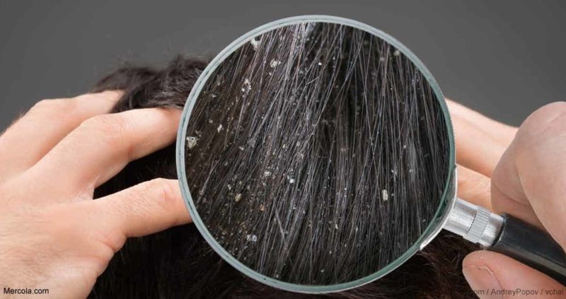Dandruff Vs Dry Scalp – What’s The Difference?