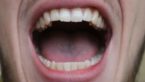 Bump Or Lump On The Roof Of Mouth: Causes,Treatment,Home Remedies
