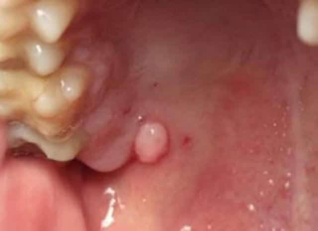 Hard Bumps In Mouth 65