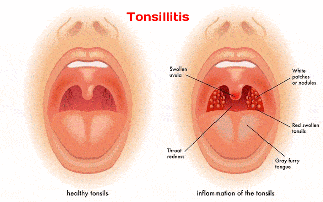 What Are White Spots On Tonsils