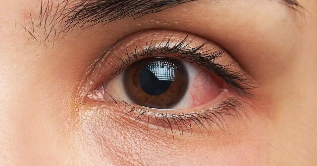 Causes Of Chemosis– Why Does It Happen