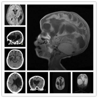 encephalomalacia