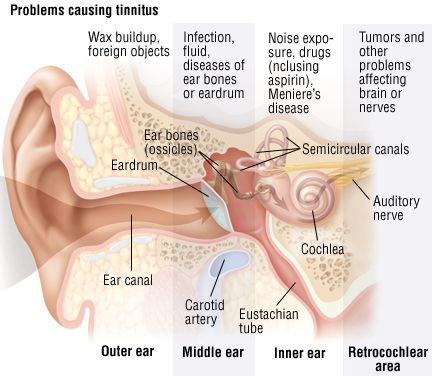 CAUSES OF FLUTTERING IN THE EAR TINNITUS