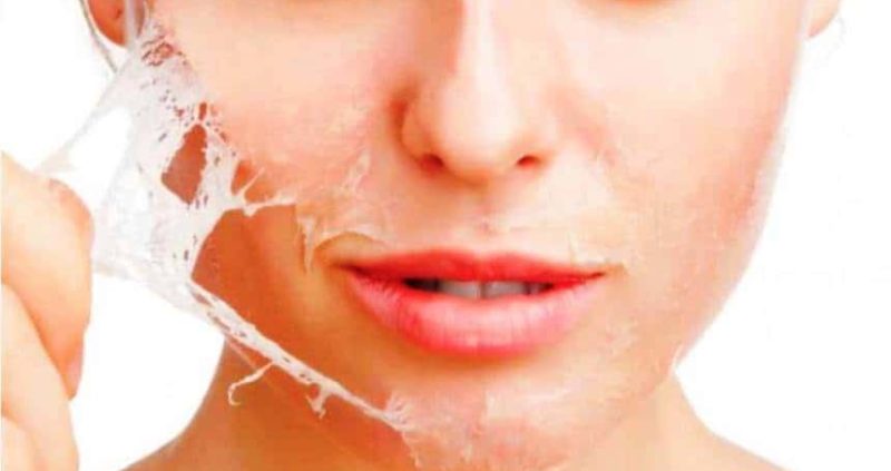 Home Remedies To Get Rid Of Peeling Skin On Face,Hand,Feet