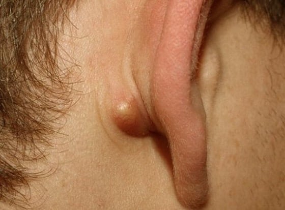 Sebaceous cysts behind ear
