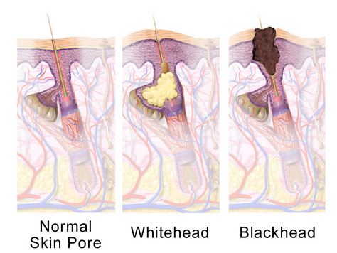 What Are Sebaceous Filaments