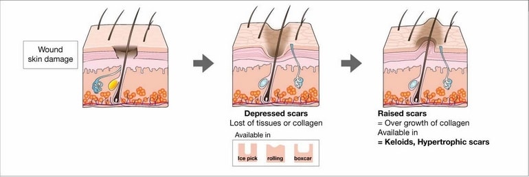 How Scar is Formed