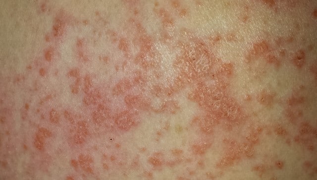 Lamictal Rash Images