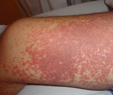 Lamictal Rash Pictures