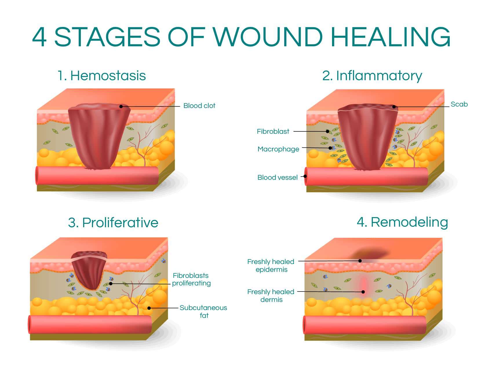 What Are The Five Stages Of Wound Healing Best Design Idea