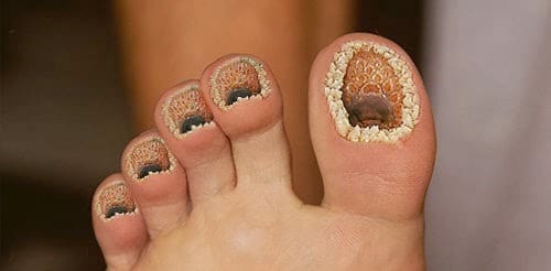 Trypophobia fear of holes On Feet
