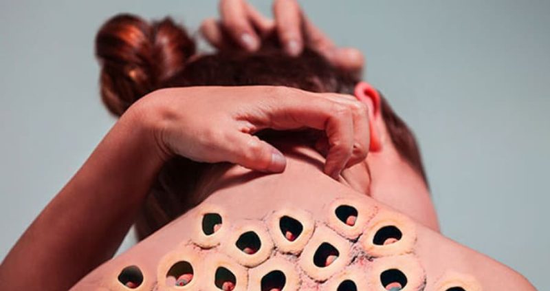 Trypophobia (Fear Of Holes On Skin) : Is This Really Exists?