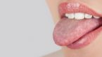 Scalloped Tongue – Causes, Diagnosis &Treatments