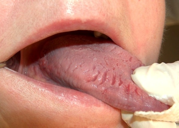 Symptoms of scalloped tongue