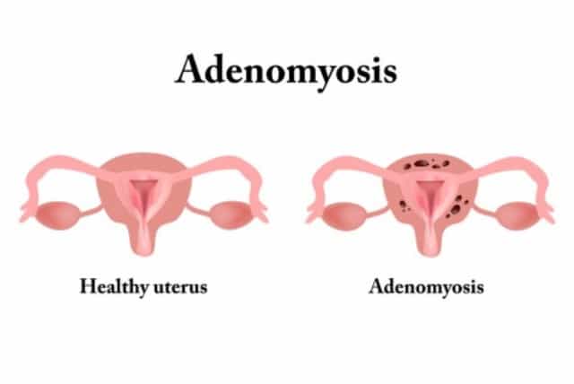 What is adenomyosis
