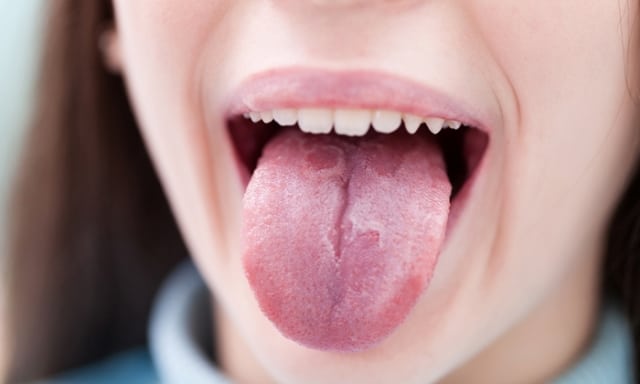 What is burning mouth syndrome