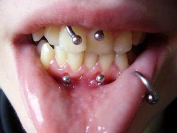 Anti-smiley piercing done on lower jaw