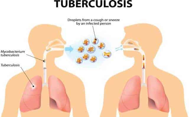 Causes of tuberculosis