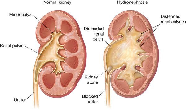Causes of hydronephrosis