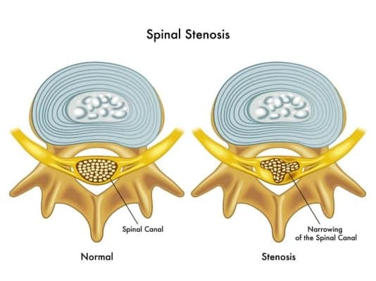 Causes of stenosis