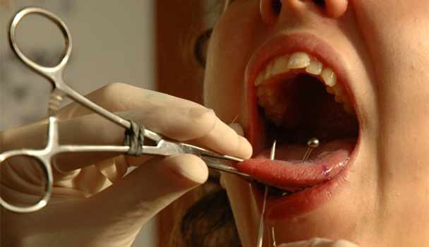 Double tongue piercing procedure
