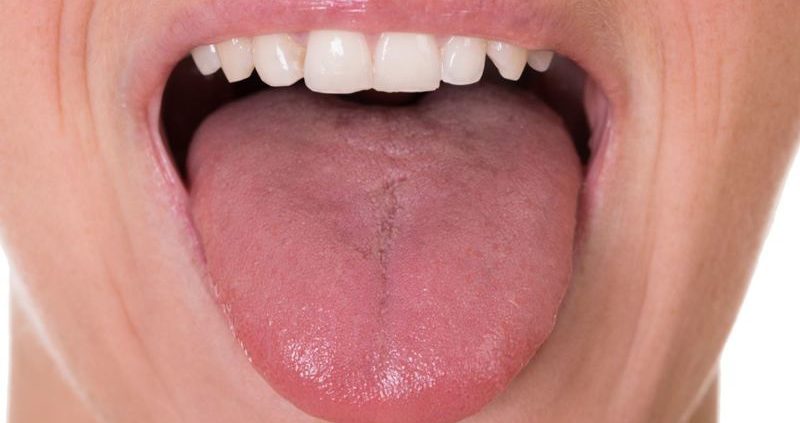 tongue papillae causes papilloma virus manifestare