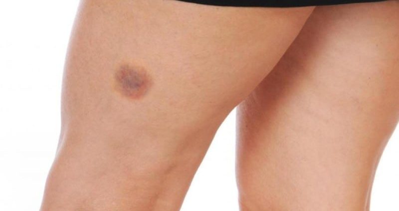 How To Get Rid Of A Hematoma?