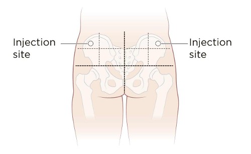 ventrogluteal injection site