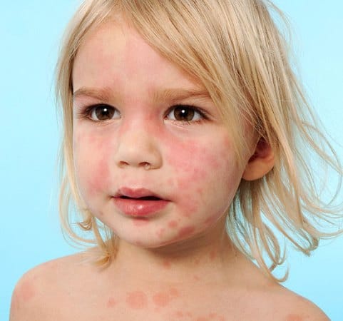 Papular Urticaria Affect Kids The Most