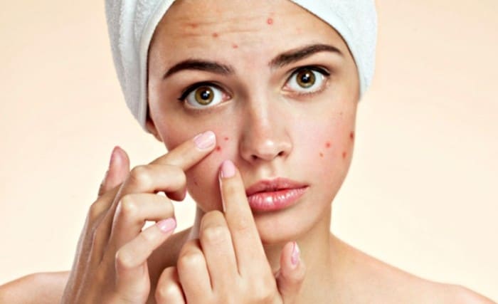Prevent acne