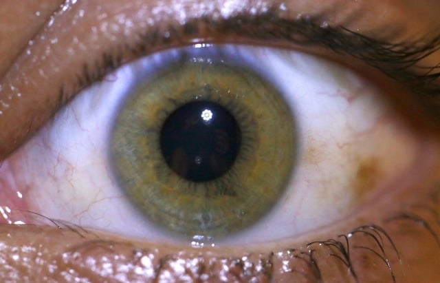 Brown Spots On The Sclera Causessymptomstreatment 