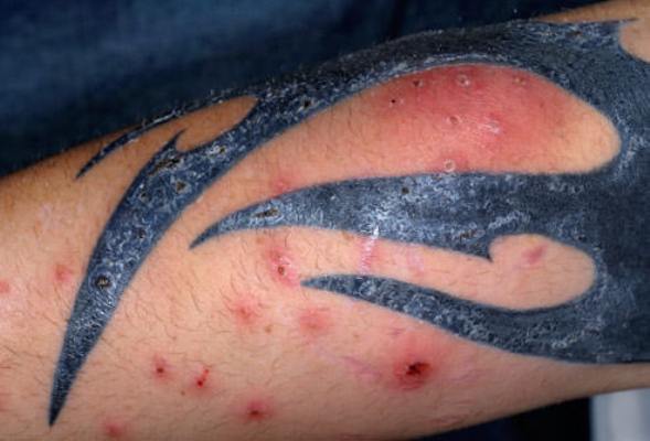 Symptoms of tattoo infection