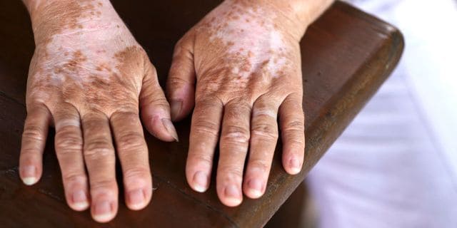 Symptoms of vitiligo