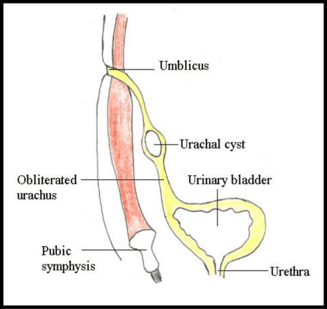 Urachal cyst