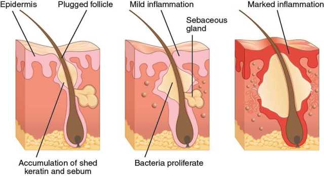 What is Folliculitis