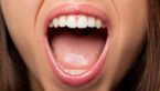 How Stop Excessive Saliva Naturally?