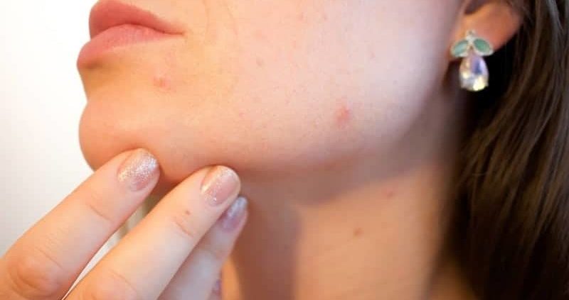 13 Effective Ways Of Using Turmeric To Cure Acne