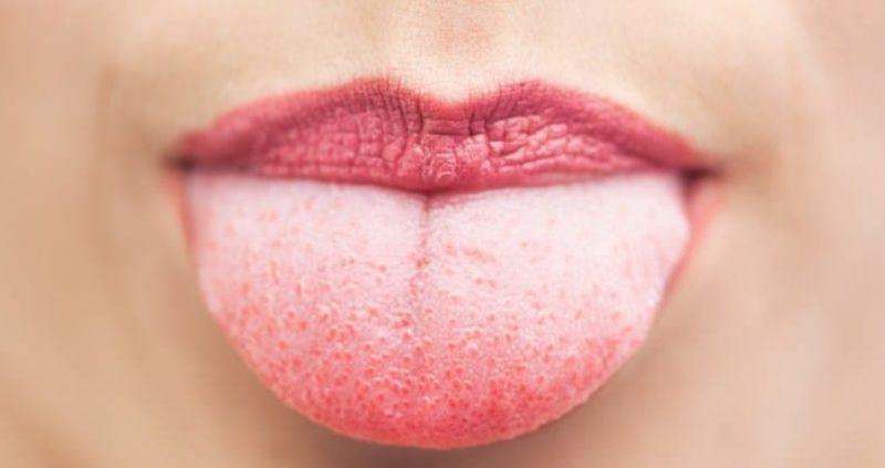 18+ Proven Home Remedies For White Furry Tongue