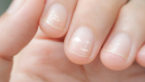 White Spot on Nails (Leukonychia)- Causes, Prevention and Treatment